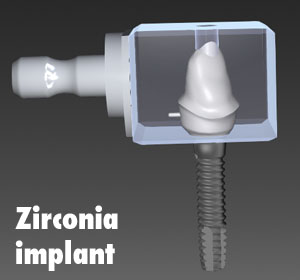 zirconia_implant_cropped_300
